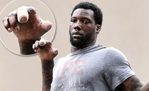 Picture of Jason Pierre-Paul injured hand.