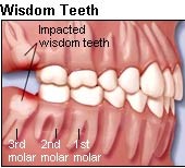 3rd molars or "Wisdom Teeth"